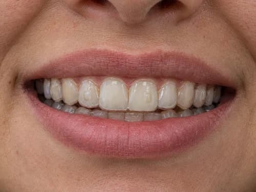 Alinhador invisível: placa transparente encaixada sobre os dentes, com a borda acompanhando a gengiva