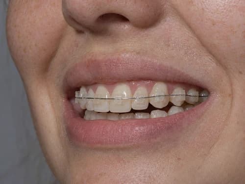 Aparelho fixo estético: braquetes de cerâmica na cor do dente, com fio fino atravessando as peças
