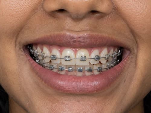 Aparelho fixo metálico: braquetes de aço colados aos dentes de cima e de baixo, ligados pelo fio ortodôntico