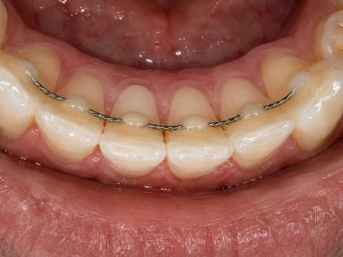 Contenção fixa: fio fino colado por trás dos dentes da frente depois que o aparelho sai