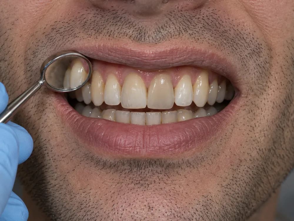 Exame com espelho clínico dos dentes escurecidos, para diagnosticar de onde vem a cor antes do clareamento