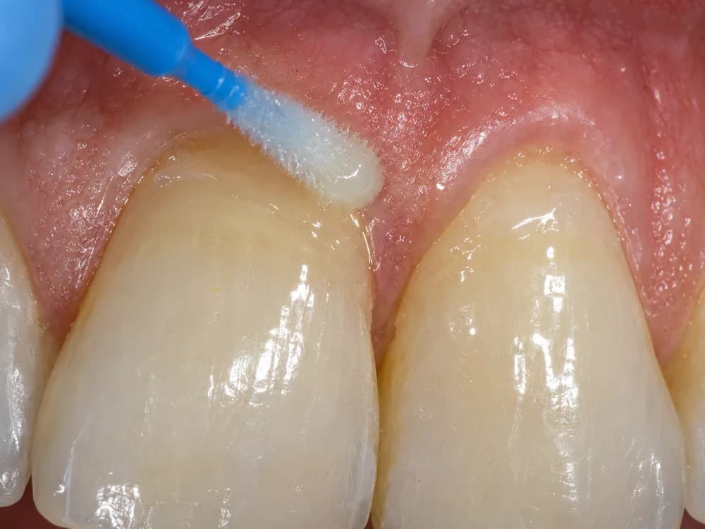 Aplicação de dessensibilizante com microbrush no colo do dente durante o clareamento