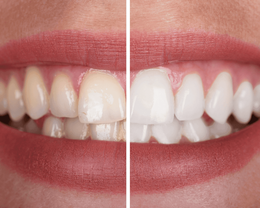 Clareamento dental na Prodentex