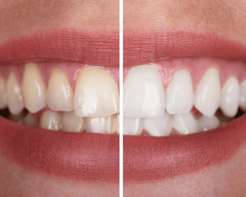 Clareamento dental na Prodentex
