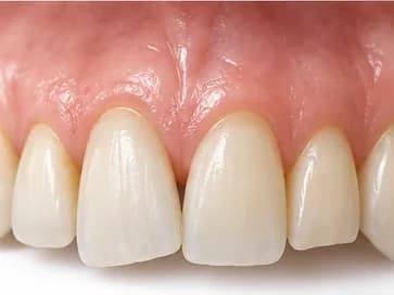 Desalinhamento leve dos dentes da frente: pequeno giro e borda fora da linha do sorriso