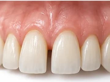 Diastema: espaço entre os dois incisivos centrais superiores, fechado alargando a forma dos dentes com a faceta