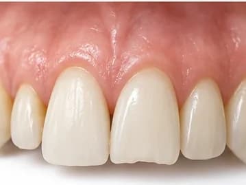 Dente da frente com borda irregular e fora da proporção em relação ao par do outro lado