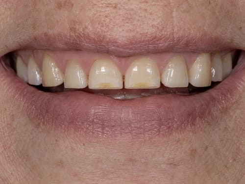 Dentes da frente encurtados pelo desgaste, com a borda achatada e a dentina exposta