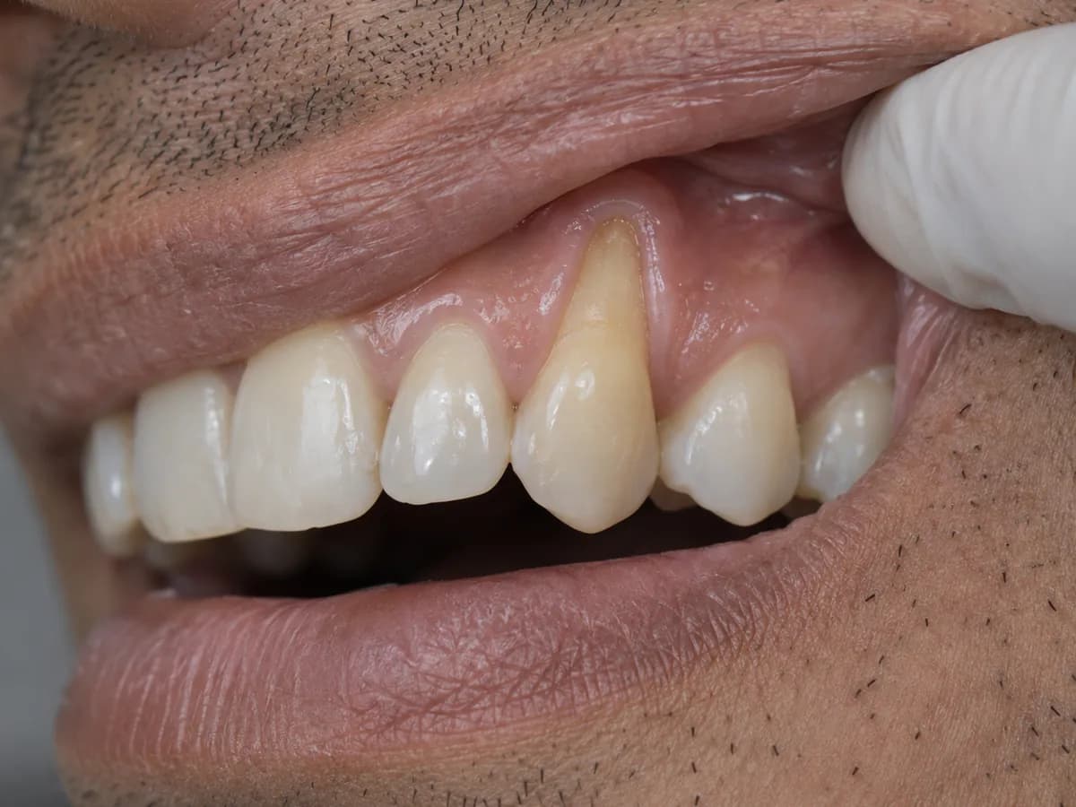 Retração gengival: raiz exposta no colo do dente, queixa tratada com enxerto gengival na Prodentex, em Joinville