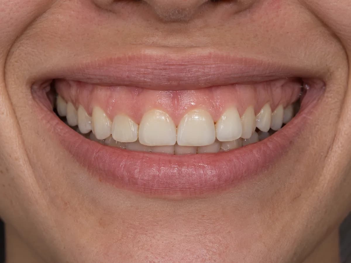 Sorriso gengival: faixa larga de gengiva sobre os dentes da frente, queixa tratada com gengivoplastia na Prodentex, em Joinville