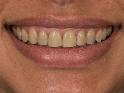 Dentes escurecidos por igual, com a gengiva saudável e na proporção correta
