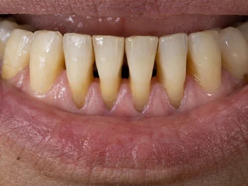 Retração com perda da papila, deixando espaços escuros triangulares entre os dentes