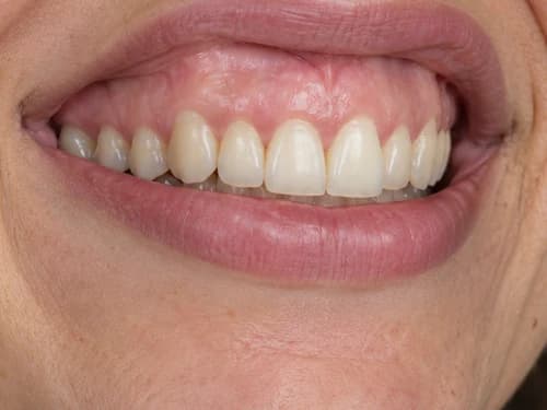 Sorriso gengival com dentes de comprimento normal: a gengiva aparece porque o lábio sobe demais