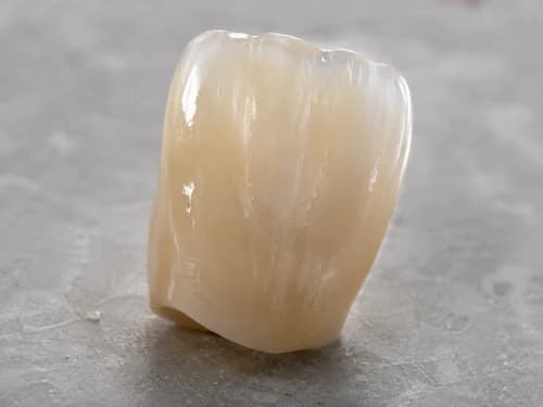 Coroa de cerâmica que cobre por inteiro o dente que perdeu estrutura