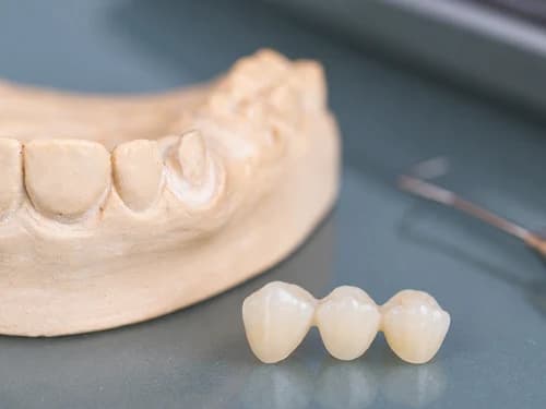 Prótese provisória em acrílico ao lado do modelo de gesso em que foi confeccionada