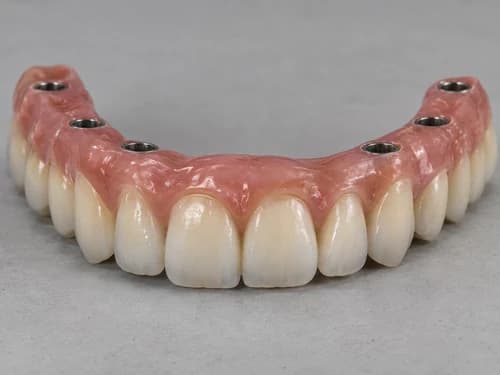 Prótese fixa sobre implante, com os canais de parafuso que prendem a peça aos implantes
