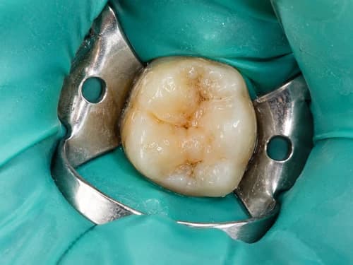 Isolamento absoluto: lençol de borracha e grampo isolando o dente que vai receber o canal