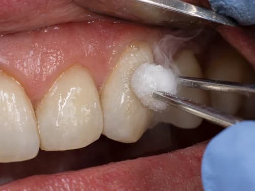 Teste de sensibilidade com pellet gelado no dente, antes de indicar o tratamento de canal