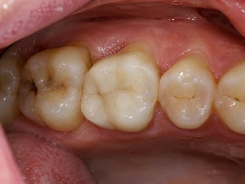 Dente restaurado depois do tratamento de canal, com o acesso selado e polido