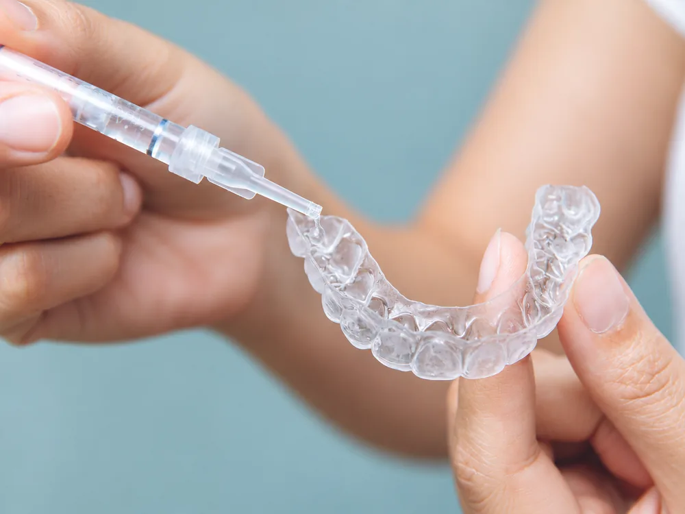 Gel clareador sendo aplicado com seringa dentro da moldeira transparente feita sob medida para o paciente