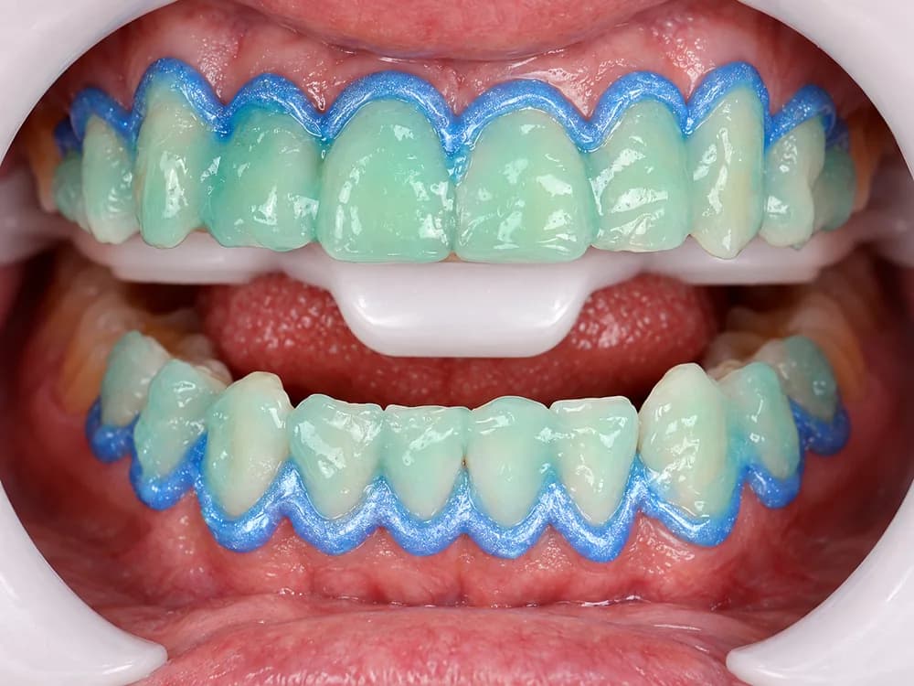 Barreira protetora azul sobre a gengiva e gel clareador cobrindo os dentes durante a sessão de consultório