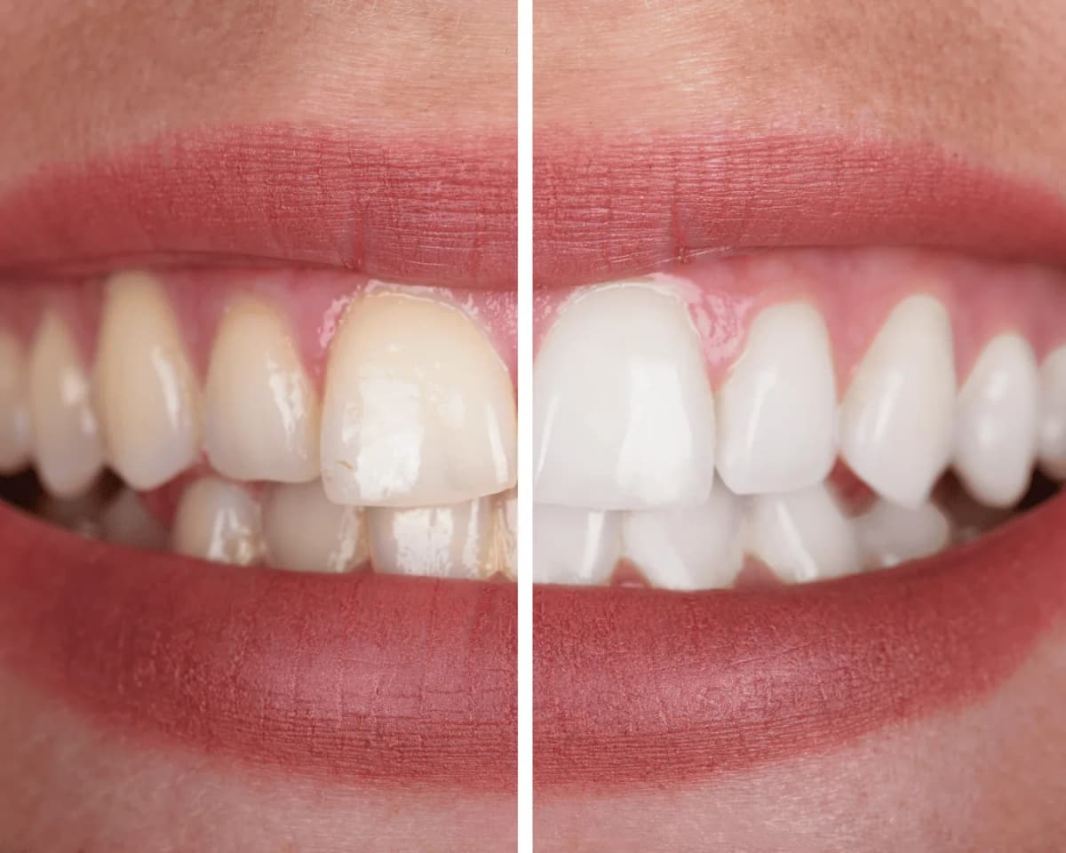 Clareamento dental em Joinville: aplicação do gel clareador com a gengiva protegida, na Prodentex