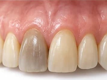 Dente escurecido entre os dentes da frente amarelados, quadro em que a faceta cobre a cor que o clareamento não resolve