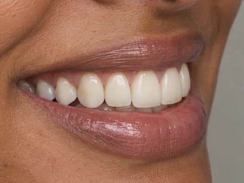 Faceta de porcelana vista de perfil, com a cor uniforme e o brilho da cerâmica