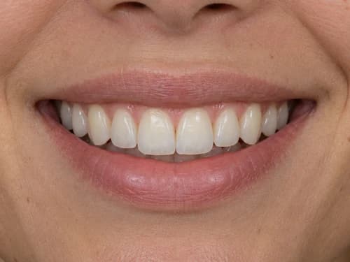 Lente de contato dentária nos dentes da frente, laminado cerâmico fino com borda translúcida