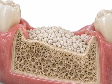 Enxerto ósseo: biomaterial repondo o volume do osso antes de instalar o implante dentário