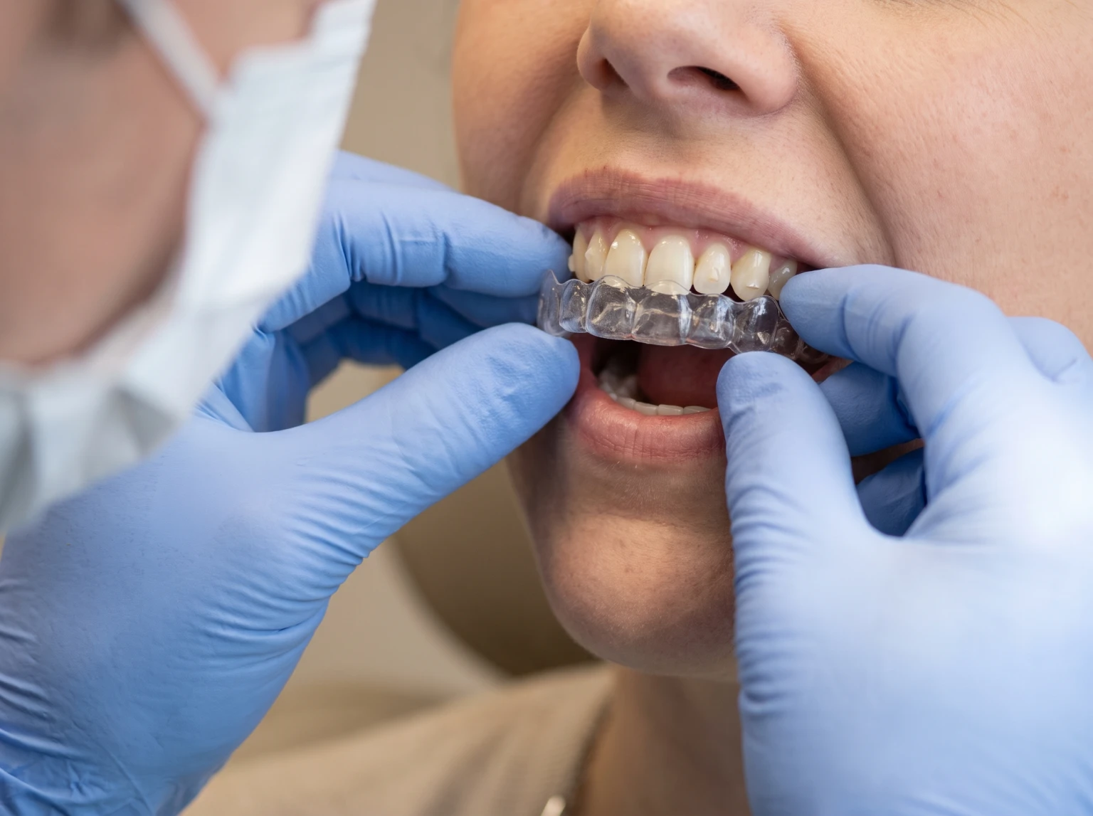 Mãos enluvadas de uma ortodontista encaixando uma placa transparente nos dentes de uma paciente, com pequenos attachments da cor do dente visíveis.
