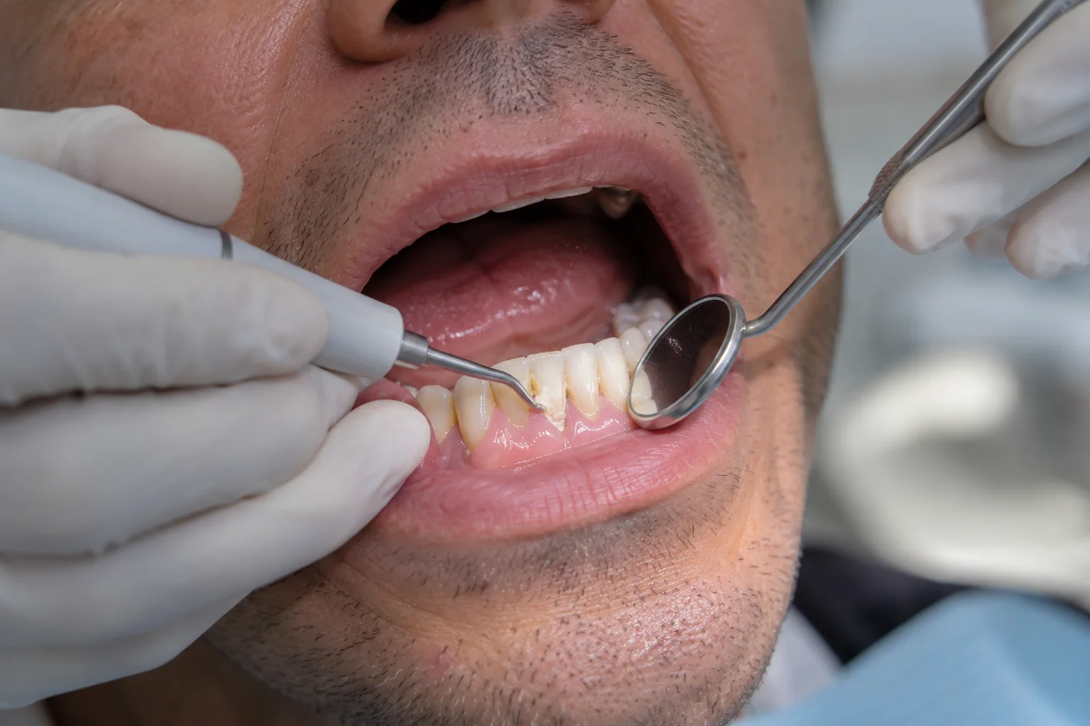 Dentista removendo tártaro com raspador ultrassônico durante a limpeza dental em consultório. Tudo para explicar limpeza dentária tira cárie.