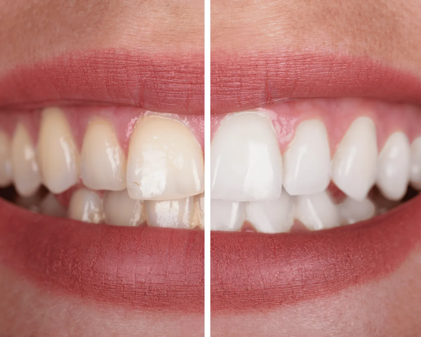 Clareamento Dental